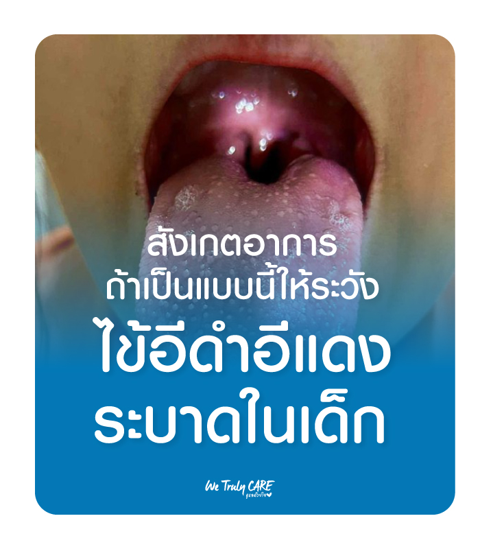 เตือนไข้อีดำอีแดงระบาดในเด็ก สังเกตอาการแบบนี้ เตรียมรับมือ