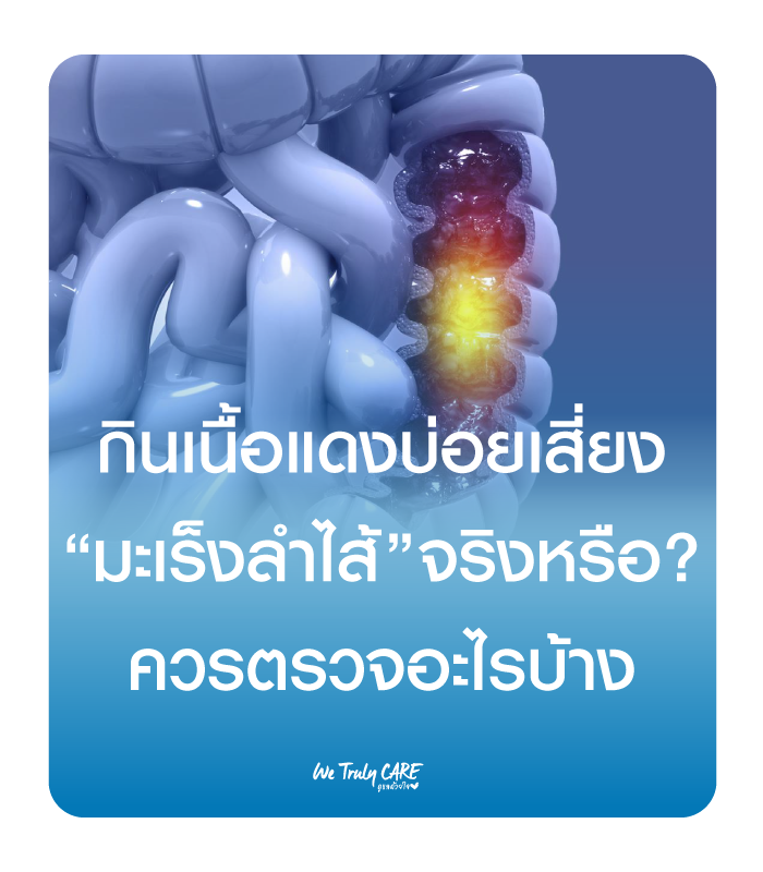 กินเนื้อแดงบ่อย เสี่ยงมะเร็งลำไส้จริงหรือ? ควรตรวจอะไรบ้าง